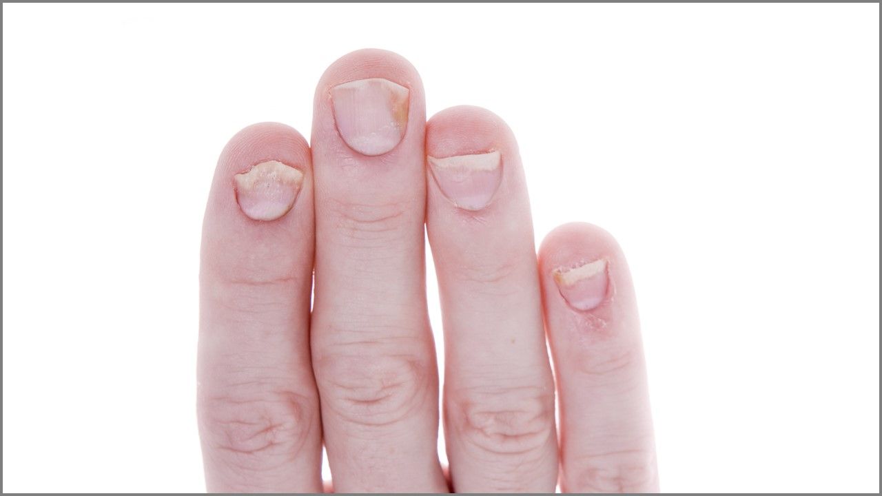 Средство против грибка стопы. Средство от грибка ногтей. Глицерин и уксус. Яблочный уксус от грибка на ногах. Йодистый глицерин.