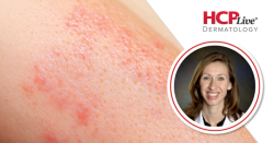 Discussing Zumilokibart Data in Atopic Dermatitis, With Ruth Ann Vleugels, MD, MPH, MBA