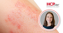 Discussing Raising HS Awareness and Treatments, With Kiera Booth, MD