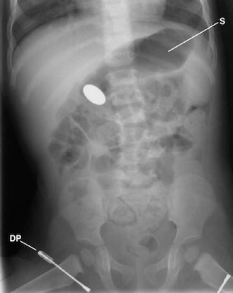 An Infant Who Swallowed a Coin