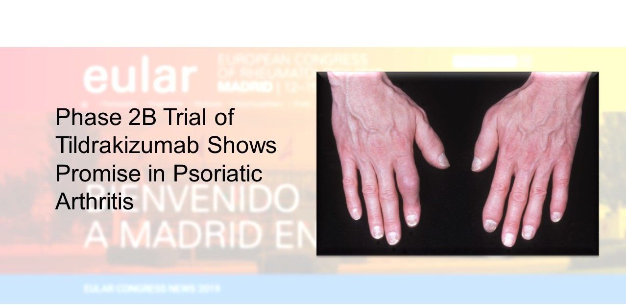 Phase 2B Trial of Tildrakizumab Shows Promise in Psoriatic Arthritis