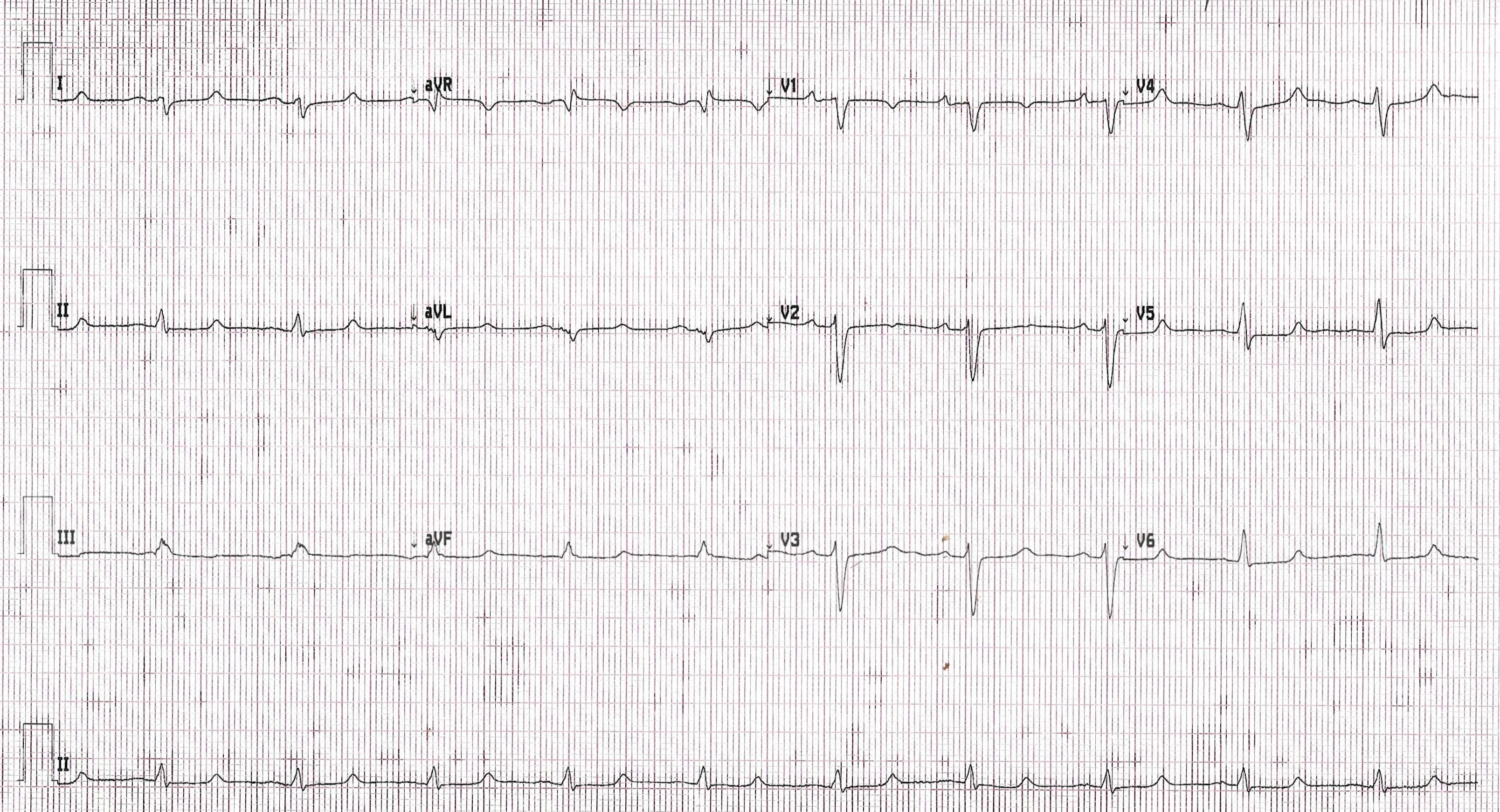 Computer print out of a patient's ECG. | Credit: Brady Pregerson, MD