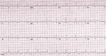 ECG Printout of a patient suffering from an acute coronary syndrome.
