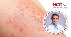 Nemolizumab Safety, Real-World Use in AD, With Matthias Augustin, MD
