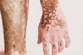Study Suggests Vitiligo Induced by Damage-Associated Molecular Patterns from Oxidative Stress