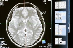 A Rare Neurological Crisis: SCD Patient Presents with Fatal Extradural Hematoma 