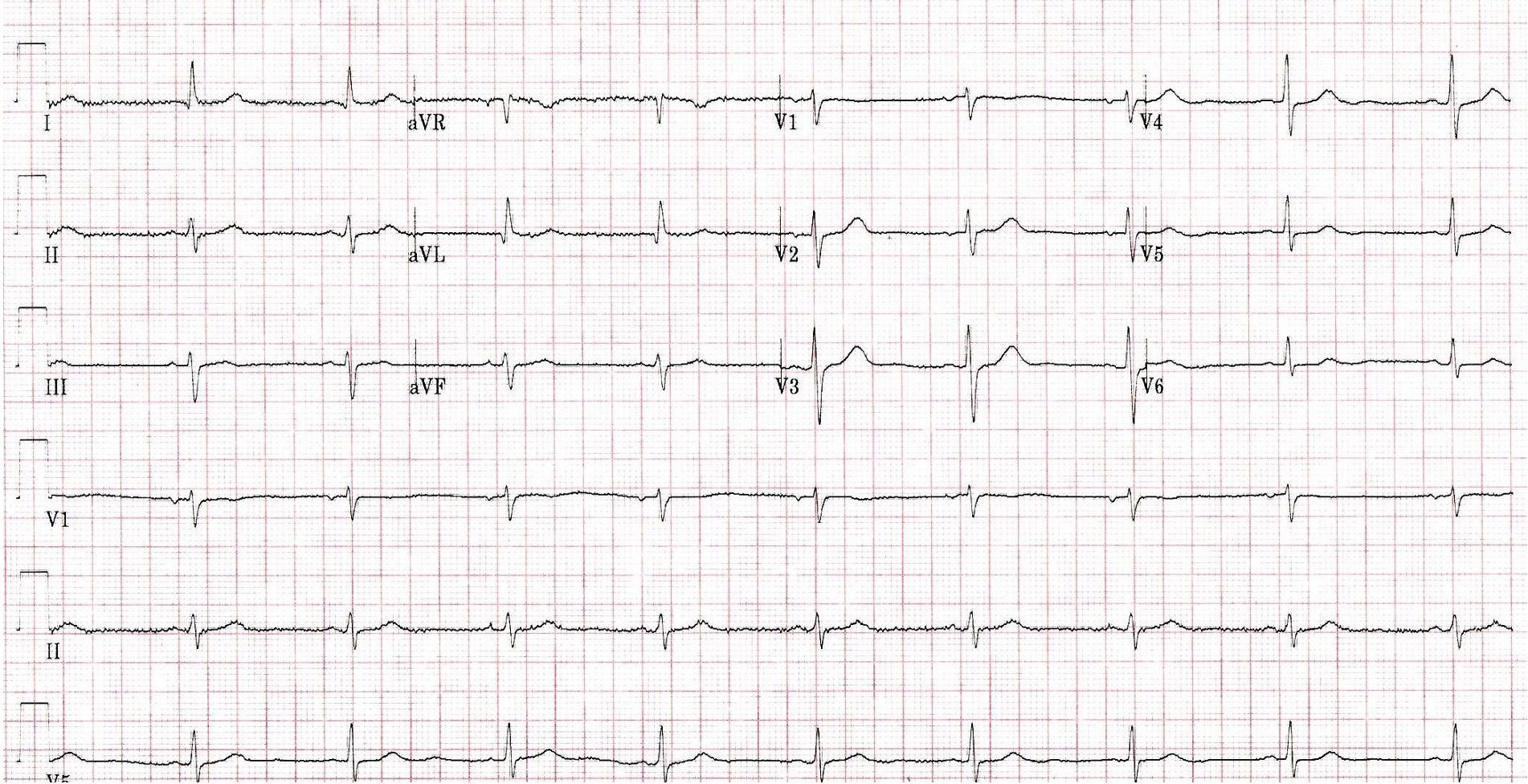 EKG printout