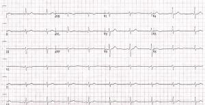 EKG printout