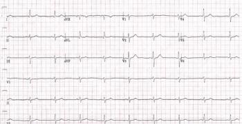 EKG printout