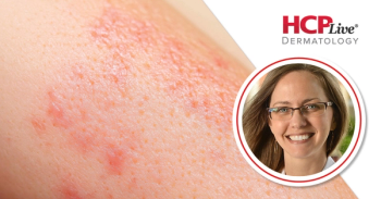 Treatment and Diagnosis Strategies for Bullous Pemphigoid, With Donna Culton, MD, PhD