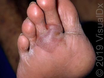 Image IQ: Diabetes and bulla on the foot