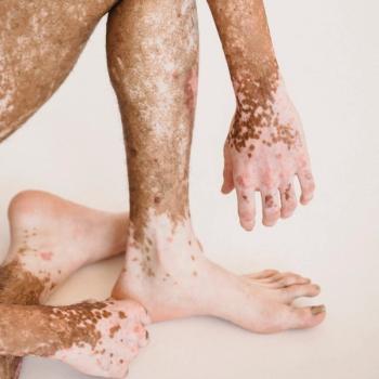 vitiligo