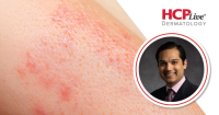 Q&A: Zasocitinib's Role Beyond Topicals in Moderate to Severe Psoriasis
