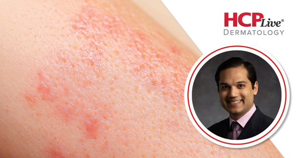 Q&A: Bimekizumab 2-Year Efficacy by HS Disease Duration, With Raj Chovatiya, MD, PhD