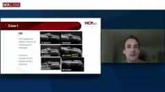 EP. 2 Single-dose faricimab in treatment-experiences eyes with nARMD: Case 1