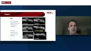 Single-dose faricimab in treatment-experiences eyes with nARMD: Case 1
