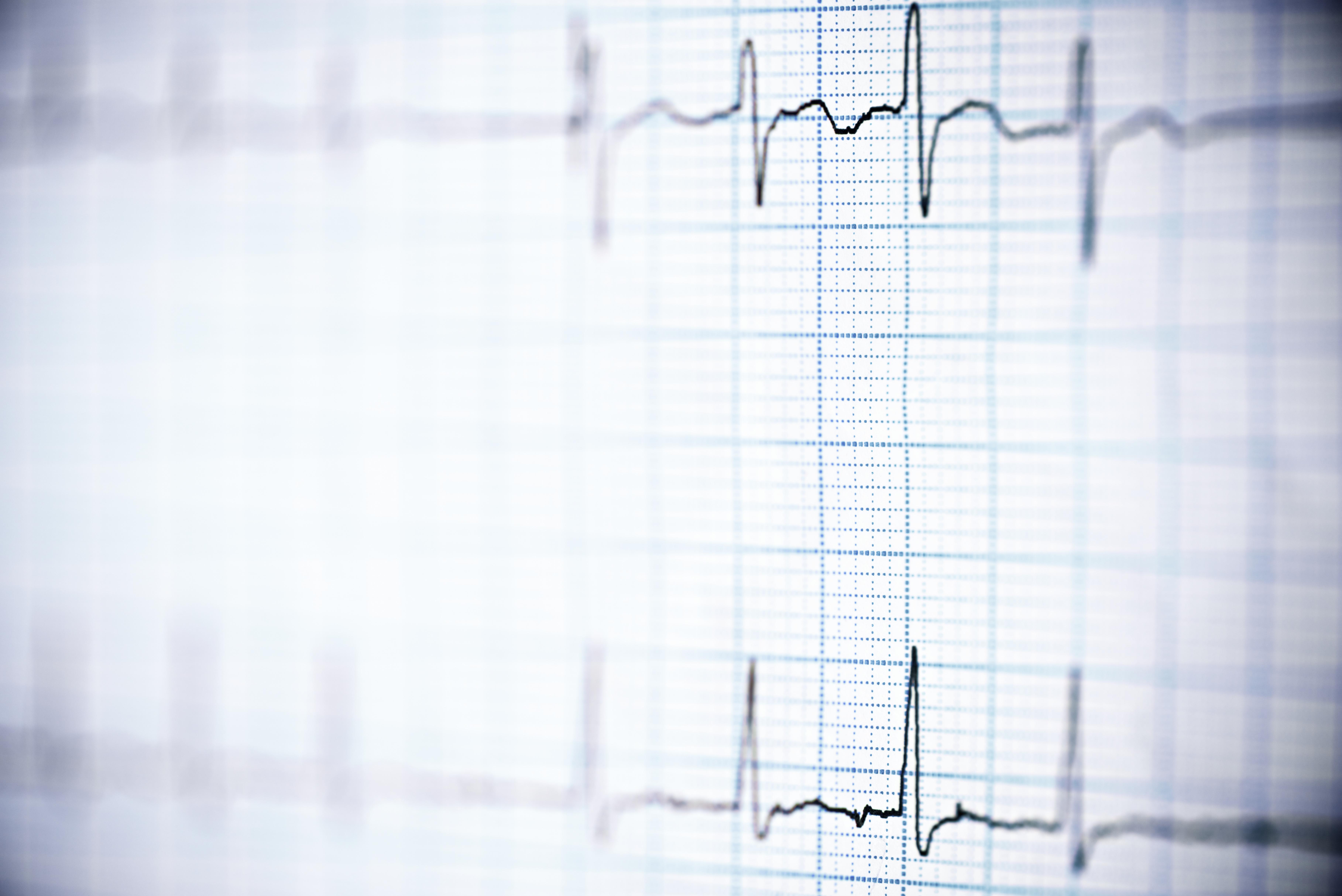 ECG printout
