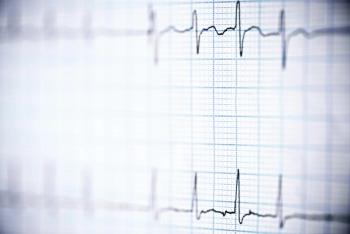 ECG printout