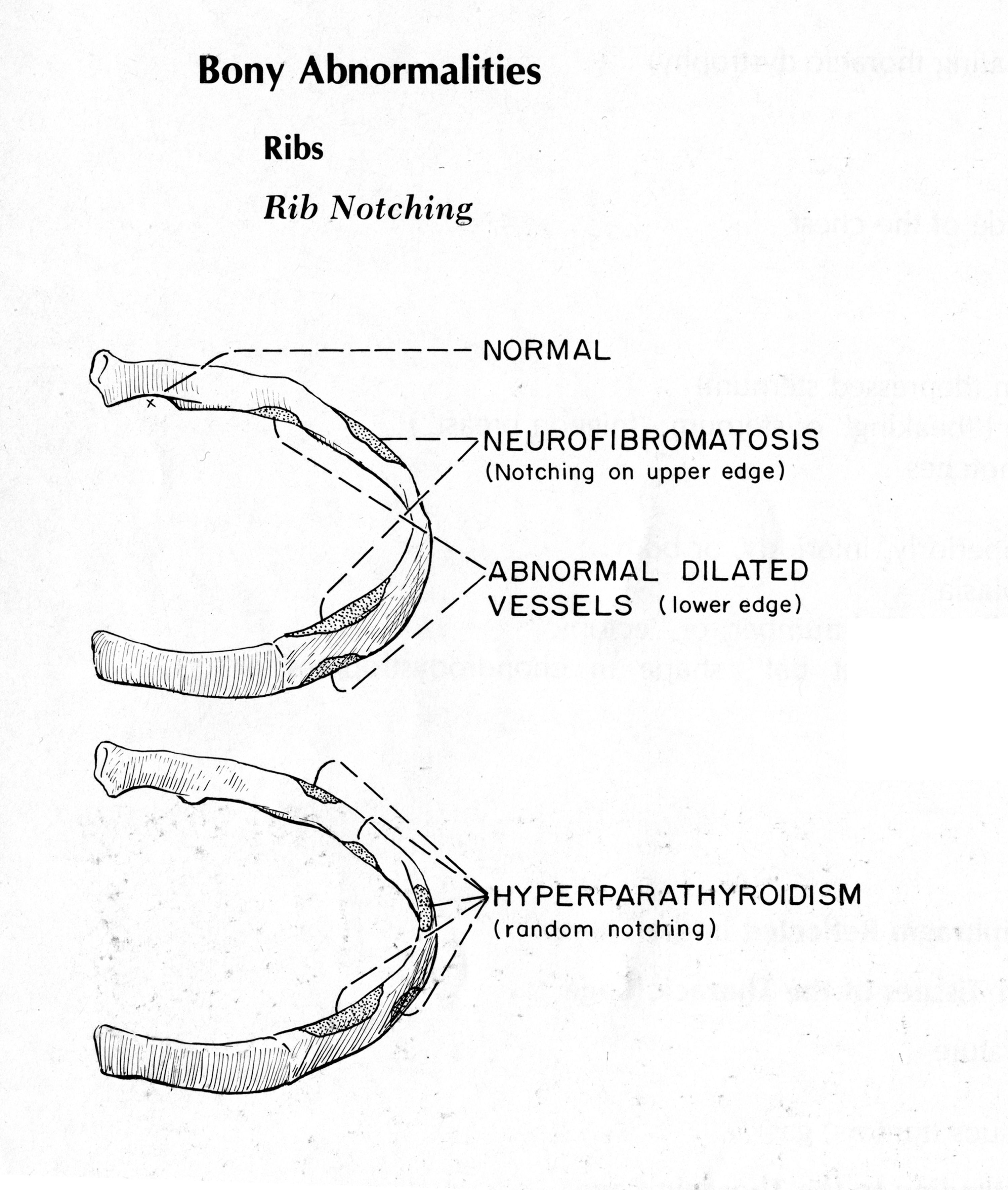 Superior Rib Notching Why Does This Young Woman with Hypertension Have Rib Notching on Her ...