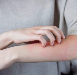 Concomitant PsA, Atopic Dermatitis Could Help Predict Treatment Response 
