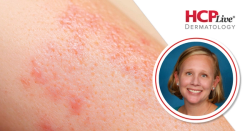 Oral Therapies and Injectables in the Psoriasis Pipeline, With Lisa Swanson, MD