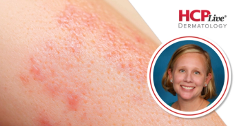Oral Therapies and Injectables in the Psoriasis Pipeline, With Lisa Swanson, MD