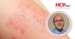 Discussing New Topical Drugs for Atopic Dermatitis in Younger Patients, With Peter Lio, MD