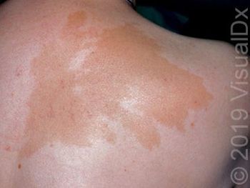 Image IQ: A 6-year-old girl with brown patches on her trunk