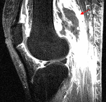 50-Year-Old Woman With Bilateral Knee Pain and Swelling