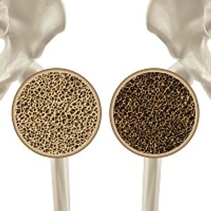 An Injection for Injectables: MIDOs Project Receives Grant for Bone-Strengthening Microspheres