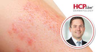 Discussing INTEGUMENT-INFANT and Roflumilast Cream 0.05% in Atopic Dermatitis, With Rocco Serrao, MD