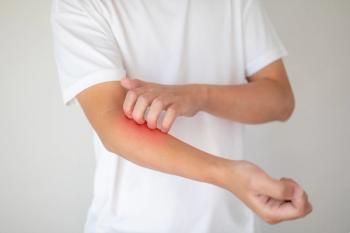 Phase 3 Data Shows Long-Term Efficacy, Safety of Stapokibart for Atopic Dermatitis