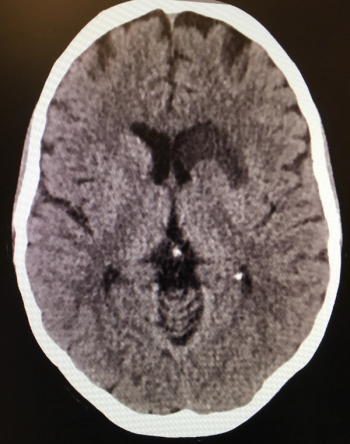 CT Scan of a patient's brain. | Credit: Brady Pregerson, MD