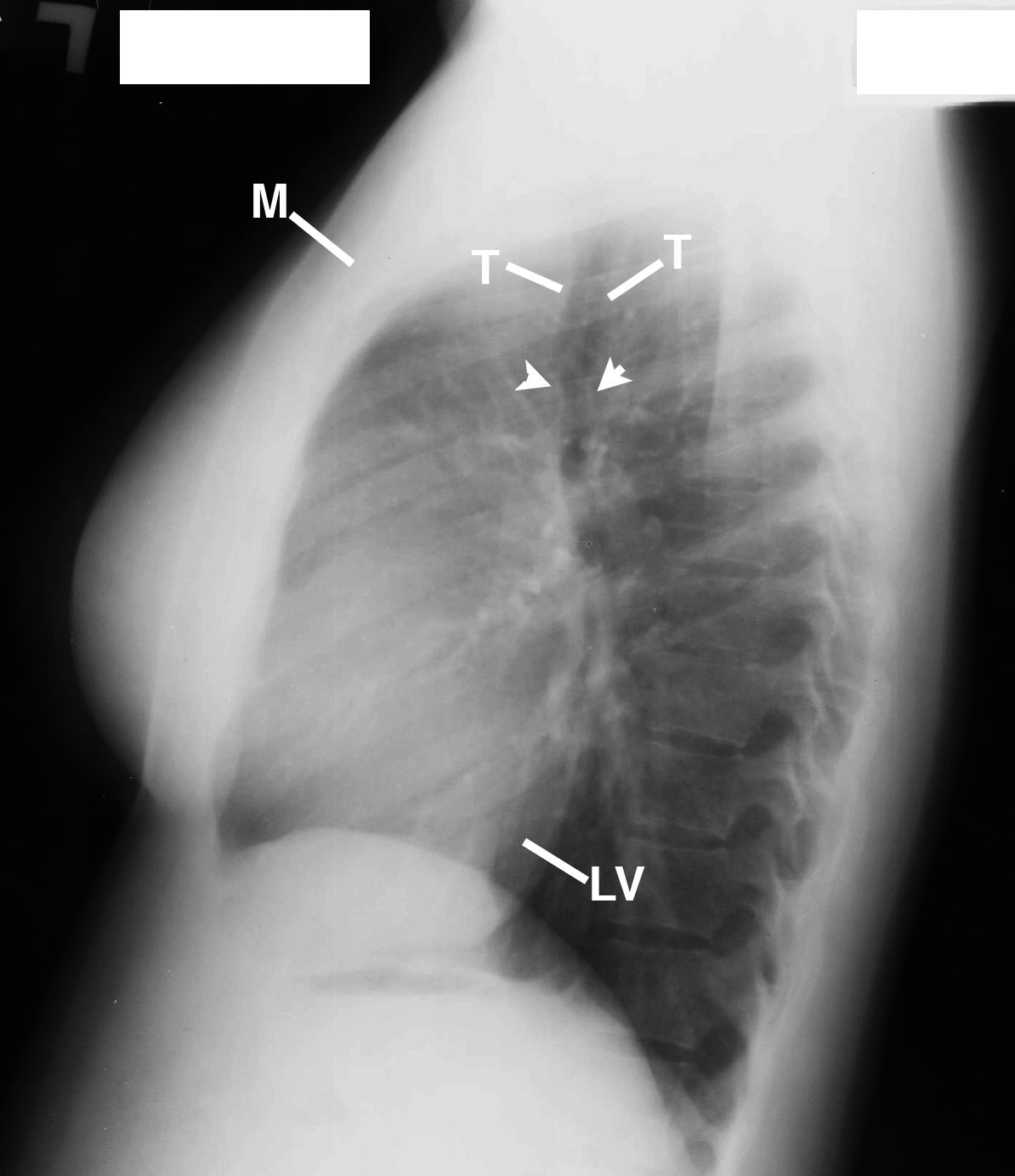 Superior Rib Notching Why Does This Young Woman with Hypertension Have Rib Notching on Her ...