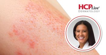 Tips for Recognizing Hidradenitis Suppurativa in Skin of Color, With Julia Riley, MD