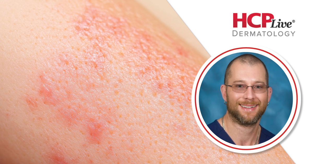 Expert Consensus Offers Age-Specific Guidance for Genital Psoriasis Care