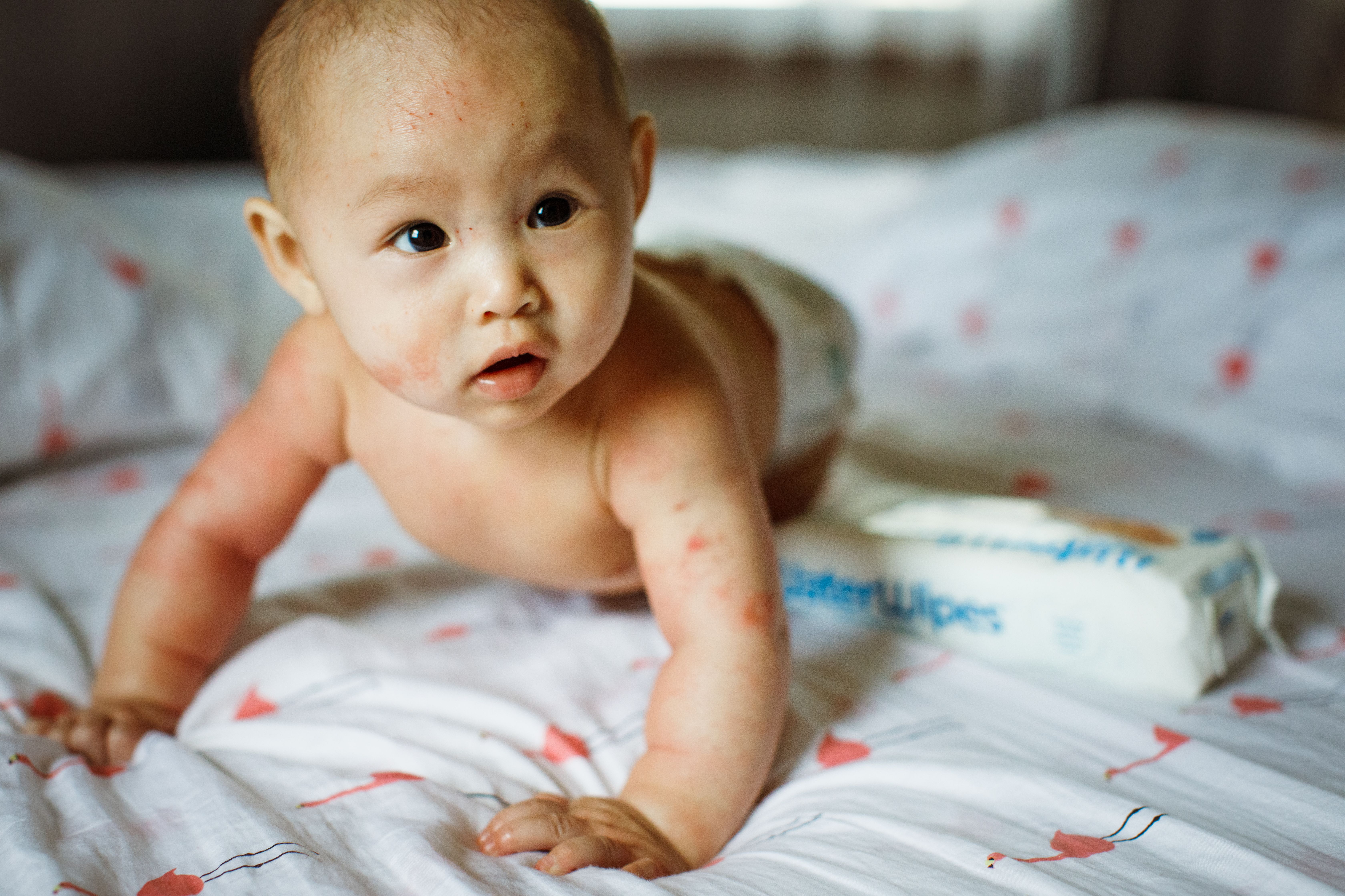 Atopic Dermatitis Prevention Evidence Based Infant Skin Care For The Primary Care Office