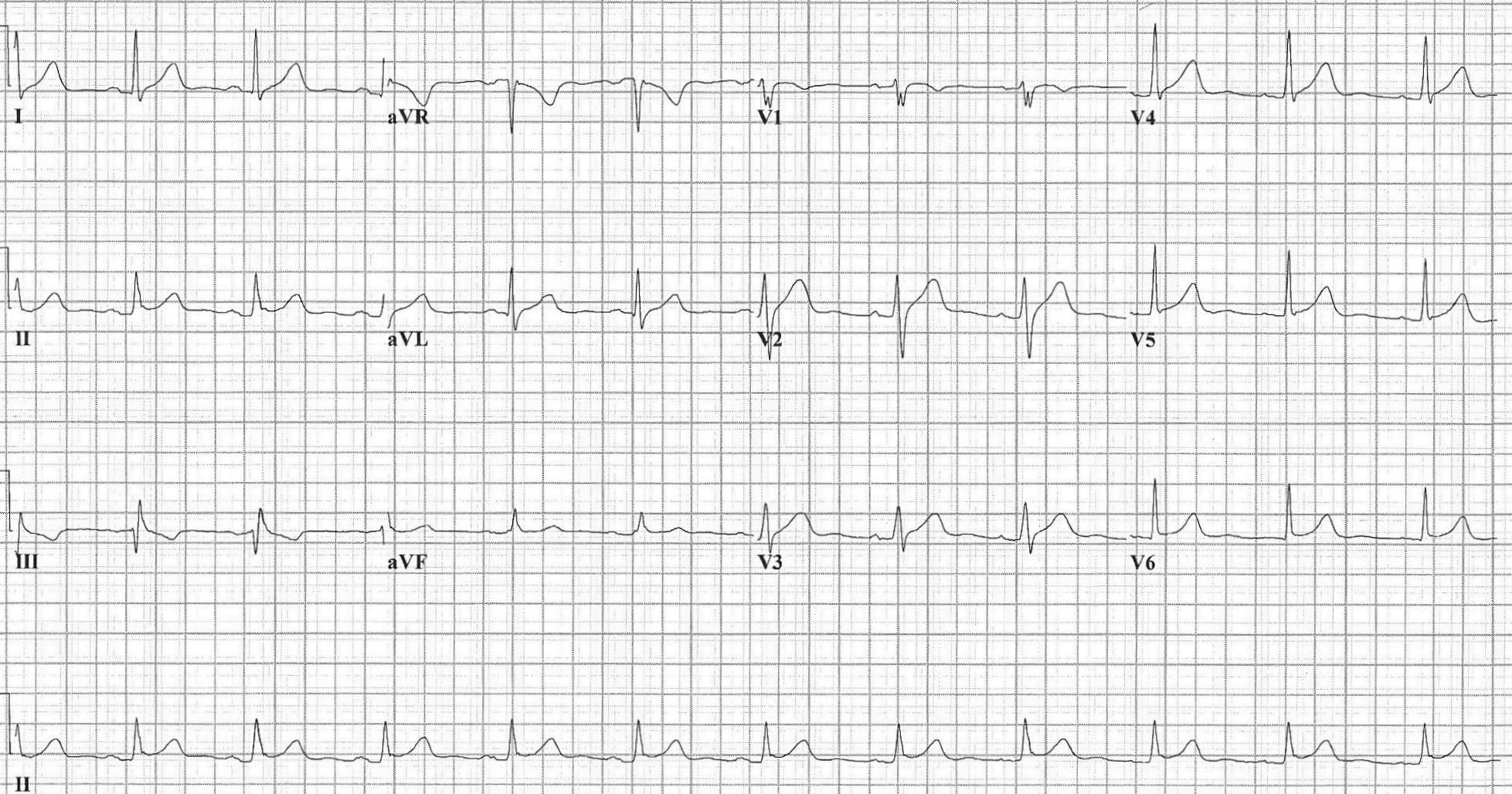 cardiology-case-report-epigastric-pain