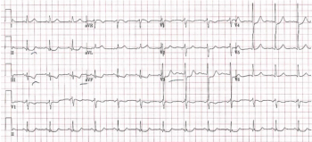 Printout of an ECG from a man in his 60s experiencing a STEMI. Computer Read: NSR 79, ST abnormality possible inferior and anterior subendocardial ischemia.