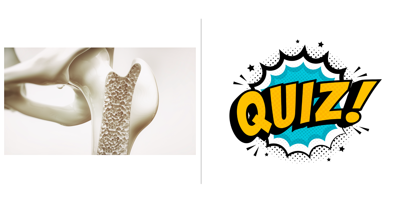 Rheumatoid Arthritis Quiz Prevention of Osteoporosis