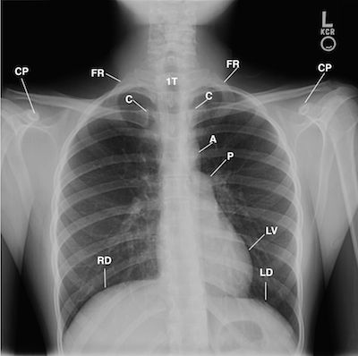 Superior Rib Notching Why Does This Young Woman with Hypertension Have Rib Notching on Her ...