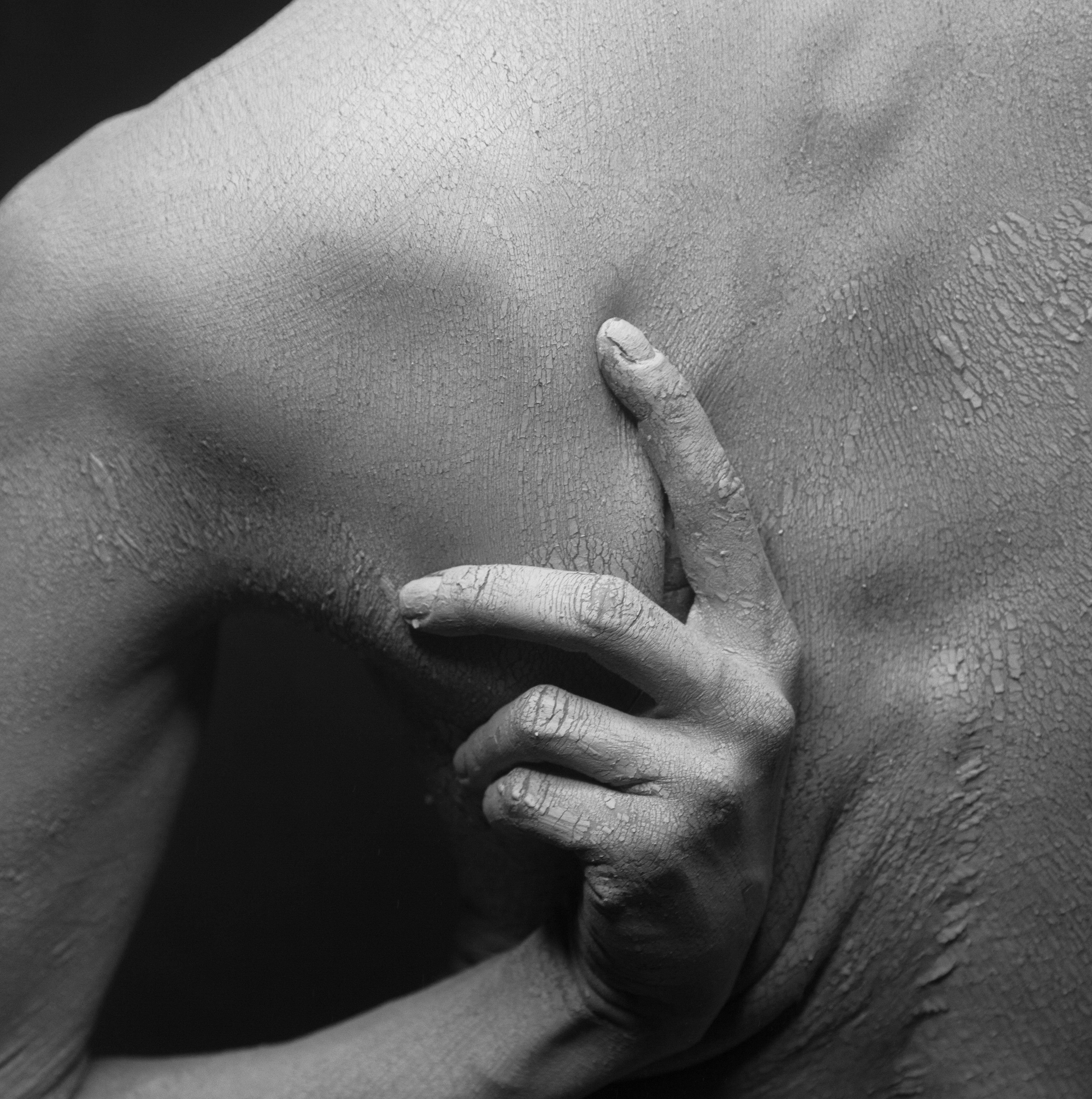 More Than 95% of Atopic Dermatitis Patients Experience Chronic Itch