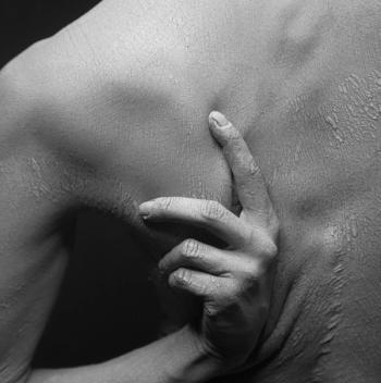 More Than 95% of Atopic Dermatitis Patients Experience Chronic Itch