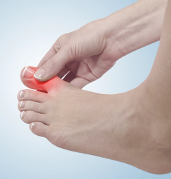 Gout Prevalence Estimated to Increase More Than 70% by 2050 