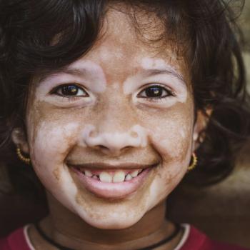 Vitiligo Linked to Reduced Risk of COVID-19 Hospitalization, Death