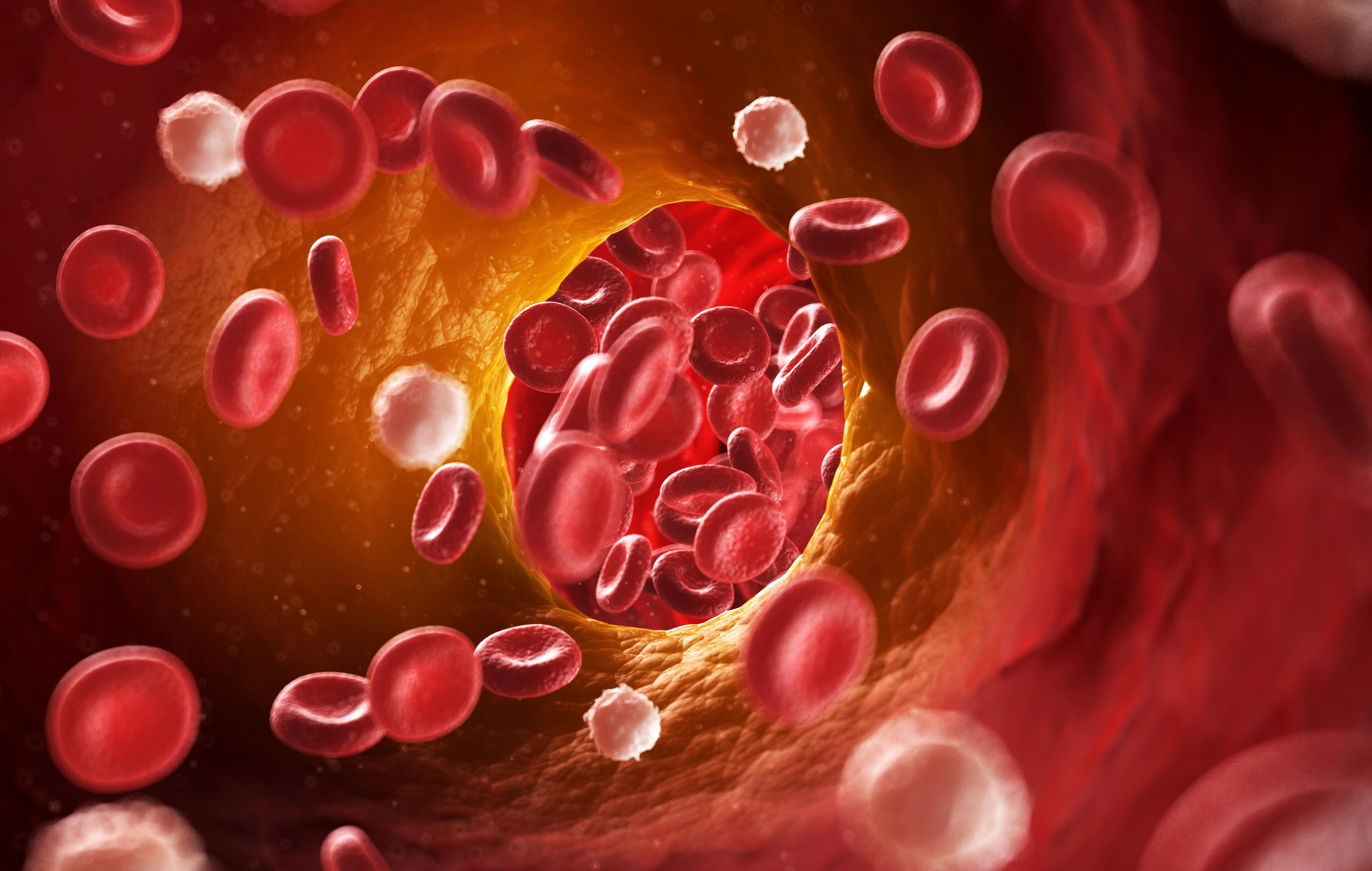 Illustration of veins showing signs of atherosclerosis