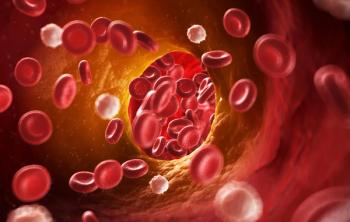Illustration of veins showing signs of atherosclerosis