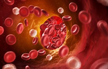 Illustration of veins showing signs of atherosclerosis