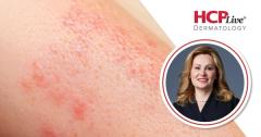 Rezpegaldesleukin Shifts Atopic Dermatitis Biomarkers: Emma Guttman-Yassky, MD