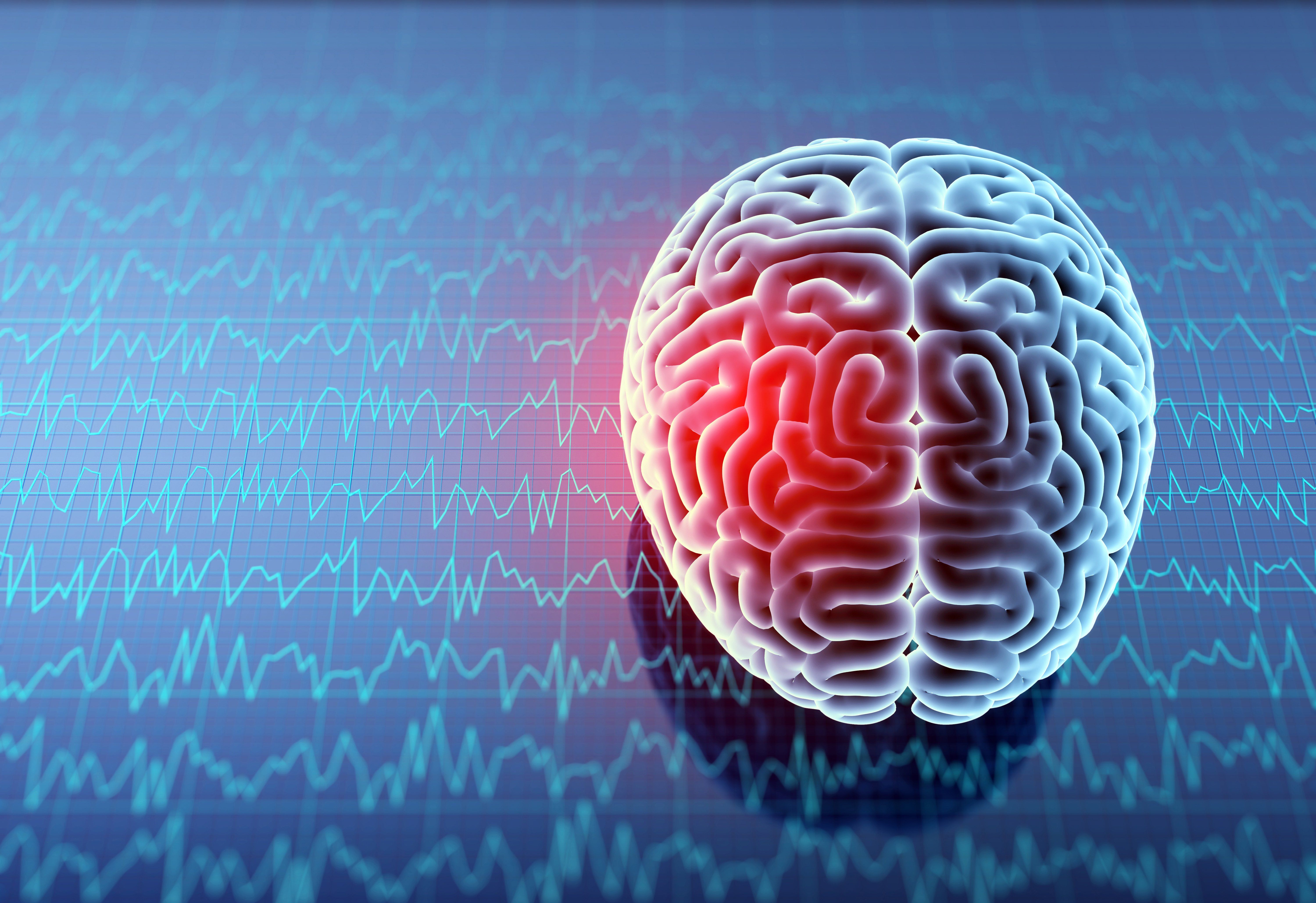 11 Percent Chance of Stroke Recurrence in AFib Patients